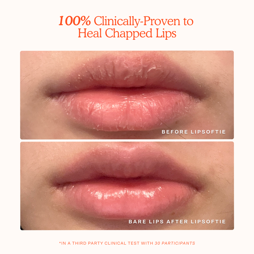 LipSoftie® Lip Treatment V5