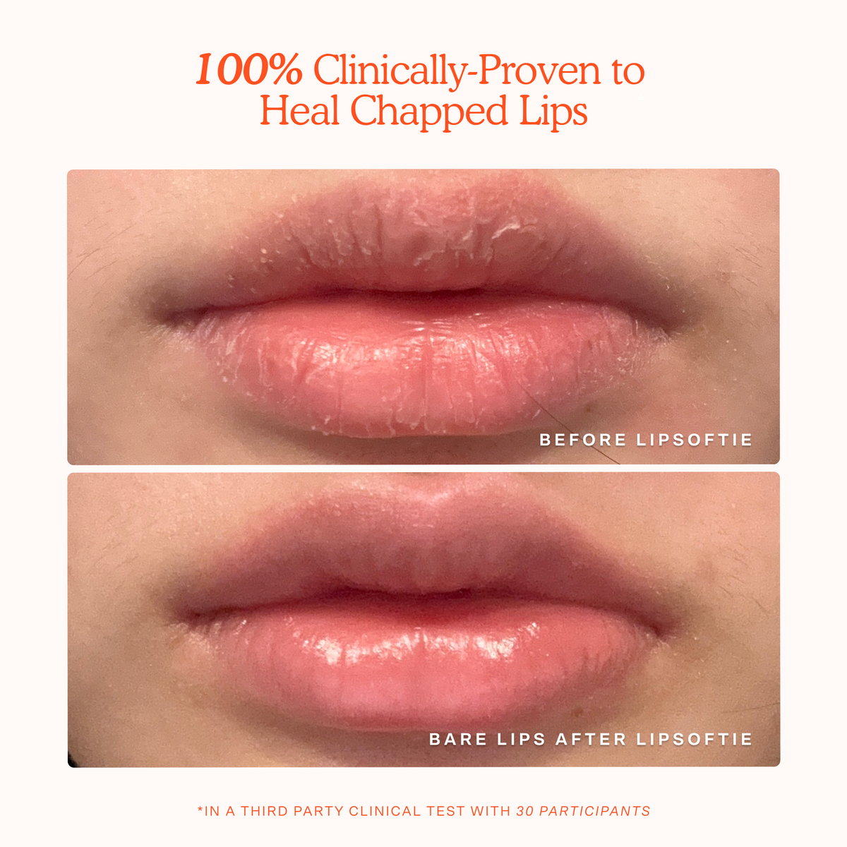 LipSoftie® Lip Treatment V5