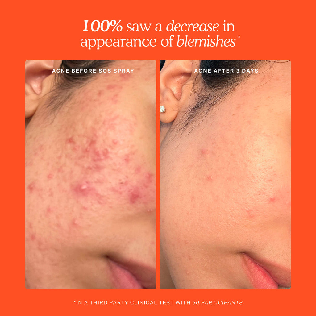 SOS Skincare Minis Kit Q1