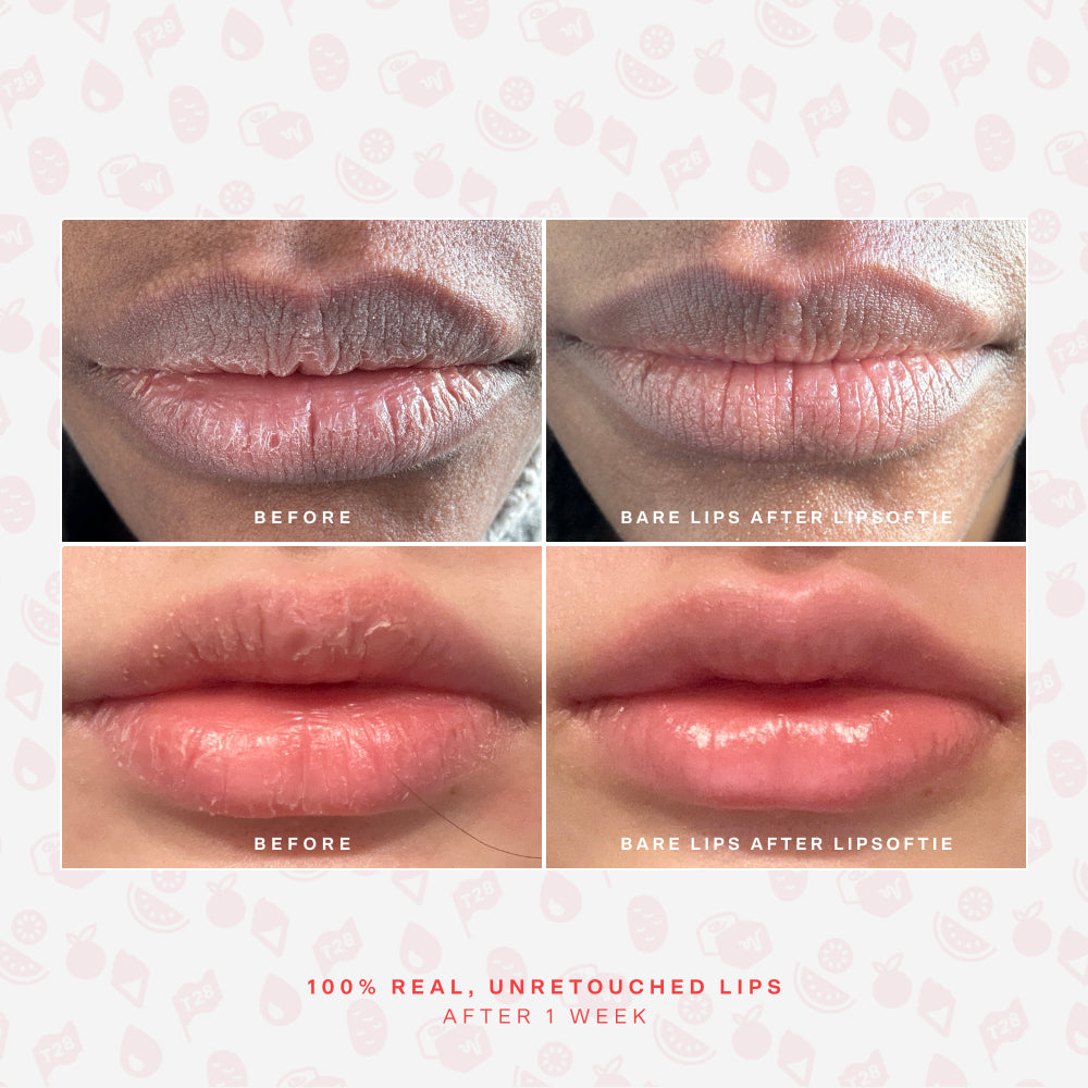 LipSoftie® Lip Treatment V5