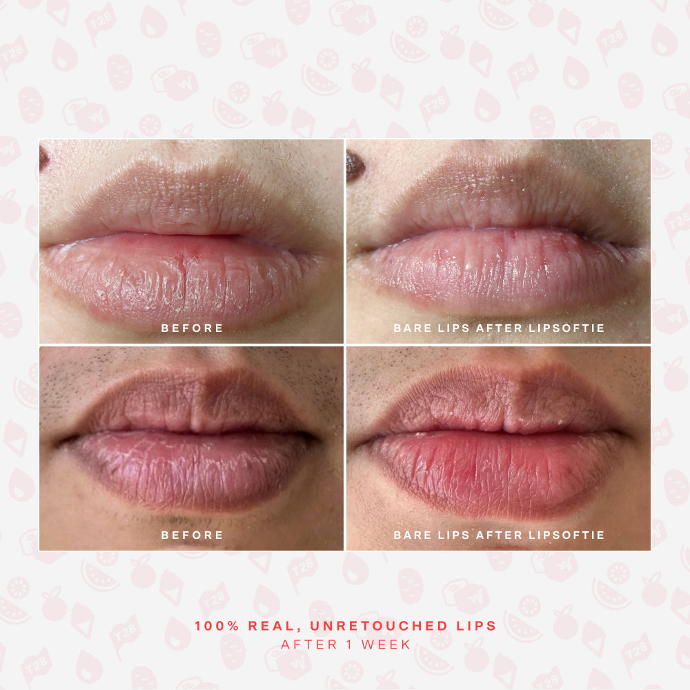 LipSoftie® Lip Treatment V5