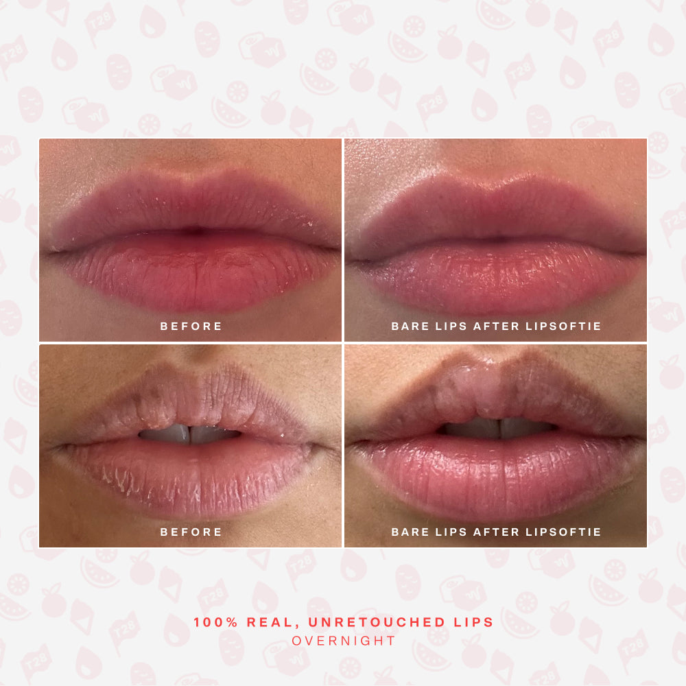 LipSoftie® Lip Treatment V5